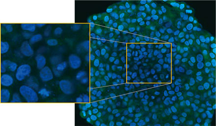   (B)  Figure 2 A and 2 B: EGFP-LC3-expressing HeLa cell spheroids (A) in normal condition and (B) treated with CQ. The enlarged images show the yellow rectangle region of the original spheroid images.  Figura 2 A e 2 B: esferoides de células HeLa que expressam EGFP-LC3 (A) em condição normal e (B) tratados com CQ. As imagens ampliadas mostram a região do retângulo amarelo das imagens esferoides originais.