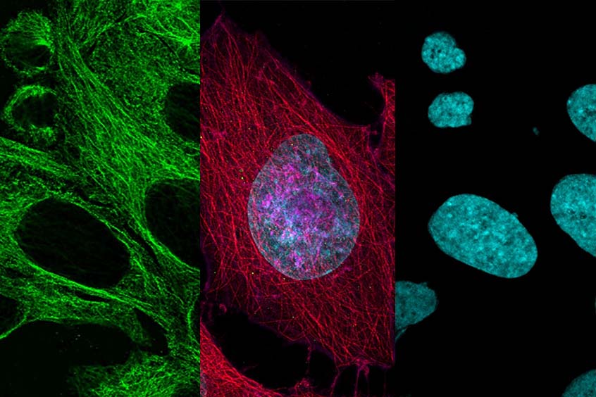 显微镜下的人宫颈癌传代细胞