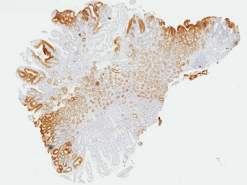 Application image of adenoma tissue sample