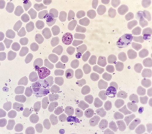 Parásito Plasmodium vivax trofozoíto en frotis de sangre con malaria 